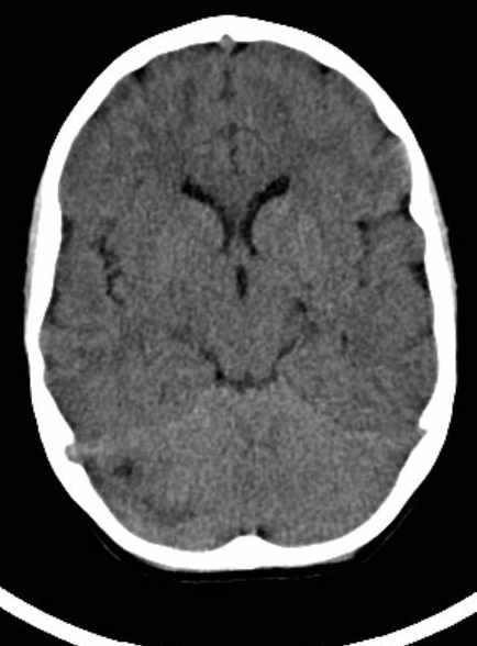 Cerebellar abscess (Radiopaedia 73727-84527 Axial non-contrast 35).jpg