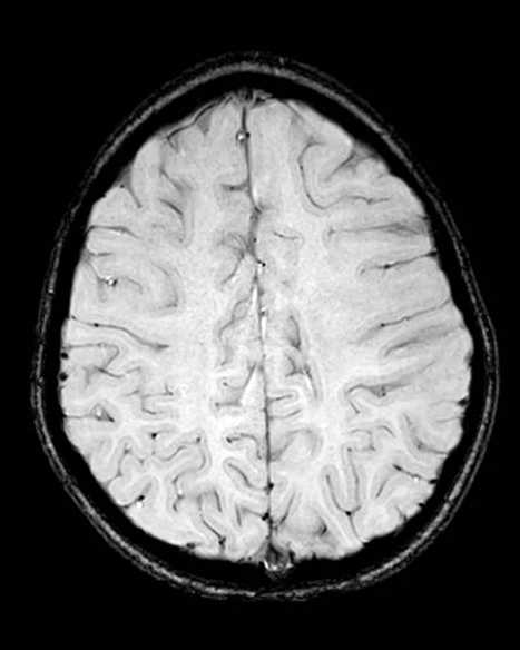 Cerebellar abscess (Radiopaedia 73727-84563 Axial SWI 54).jpg