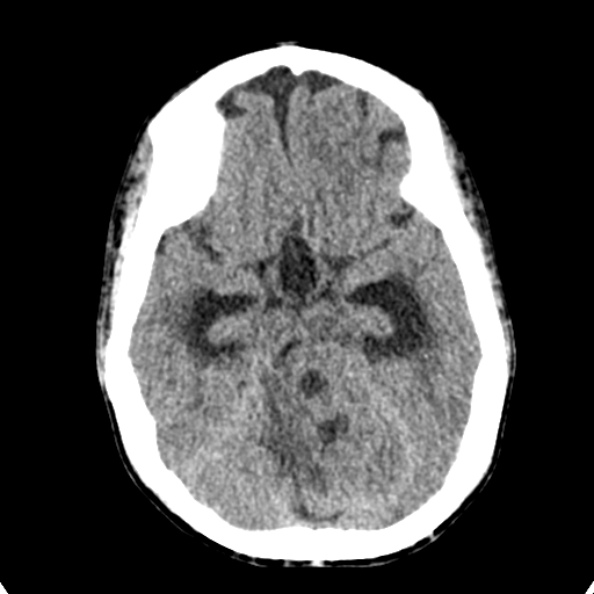 File:Cerebellar abscess secondary to mastoiditis (Radiopaedia 26284-26412 Axial non-contrast 57).jpg