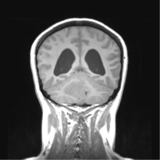 Cerebellar ependymoma complicated by post-operative subdural hematoma (Radiopaedia 83322-97736 Coronal T1 40).png