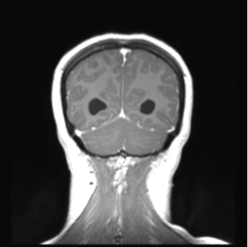 Cerebellar ependymoma complicated by post-operative subdural hematoma (Radiopaedia 83322-97736 Coronal T1 C+ 47).png