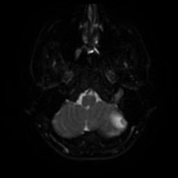 Cerebellar hemangioblastoma (Radiopaedia 29570-30077 Axial DWI 31).jpg