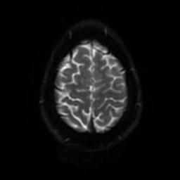 Cerebellar hemangioblastoma (Radiopaedia 29570-30077 Axial DWI 49).jpg