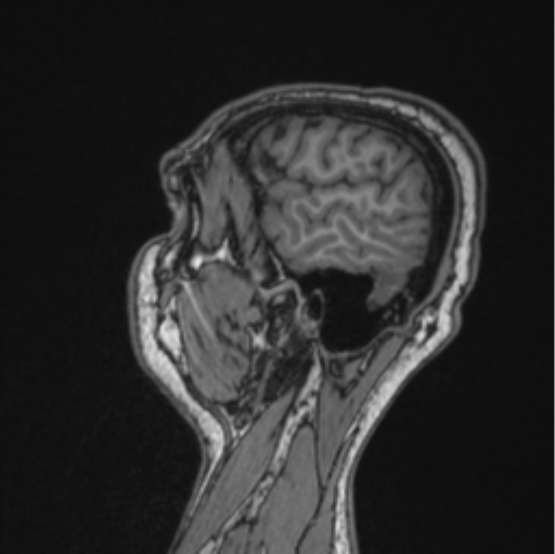 Cerebellar hemangioblastomas and pituitary adenoma (Radiopaedia 85490-101176 Sagittal T1 27).png