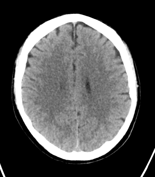 File:Cerebellar hemorrhage (Radiopaedia 37000-38669 Axial non-contrast 26).png