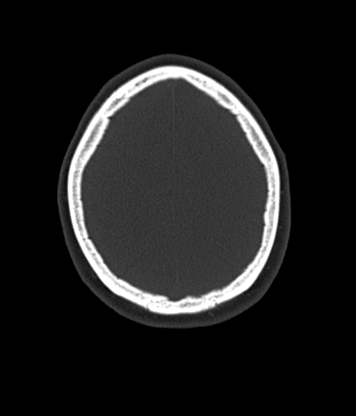 Cerebellar metastases - colorectal adenocarcinoma (Radiopaedia 40947-43652 AX Bone C- 2.0 MPR 53).png