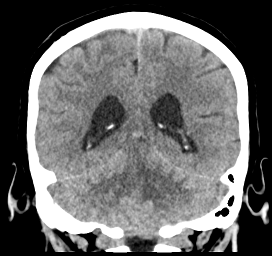 Cerebellar metastasis (Radiopaedia 54578-60812 Coronal non-contrast 39).png