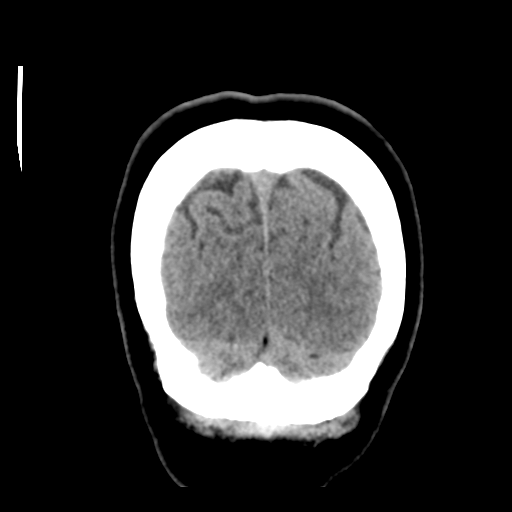 Cerebellar metastasis (cystic appearance) (Radiopaedia 41395-44258 Coronal non-contrast 55).png