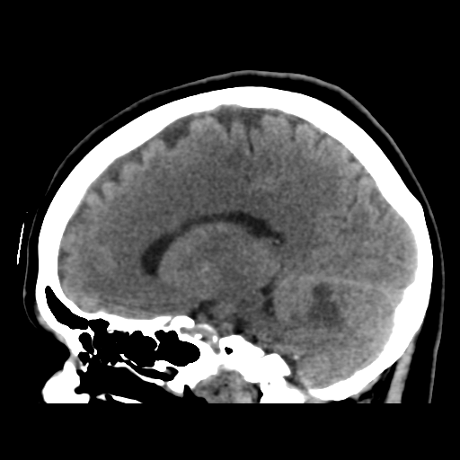 File:Cerebellar metastasis (cystic appearance) (Radiopaedia 41395-44258 E 34).png