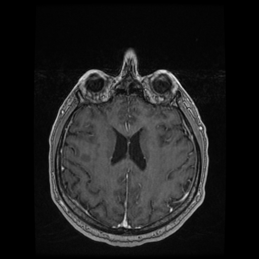 Cerebellar metastasis of pulmonary adenocarcinoma, cavernous venous malformation, and developmental venous anomaly (Radiopaedia 85827-101661 Axial T1 C+ 63).jpg