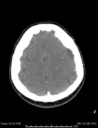 File:Cerebellar strokes due to intracranial giant cell arteritis (Radiopaedia 68799-78510 CT angiogram 23).jpg