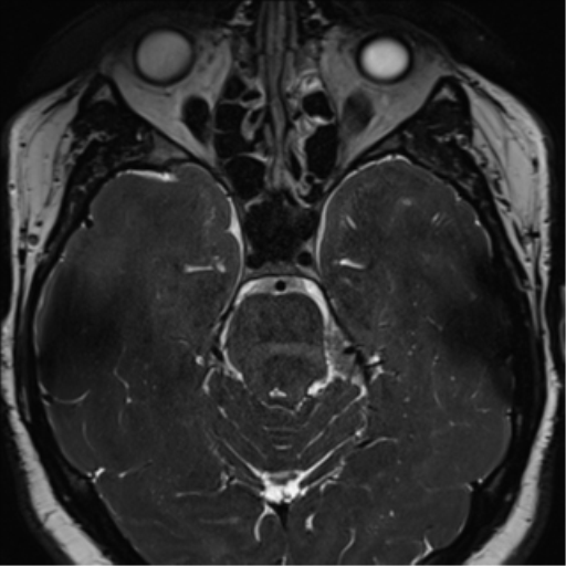 Cerebellopontine angle meningioma (Radiopaedia 48434-53348 Axial T2 Space 83).png
