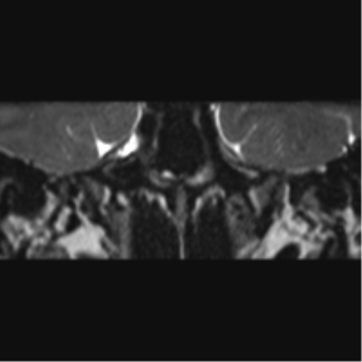 Cerebellopontine angle meningioma (Radiopaedia 48434-53348 Coronal T2 69).png