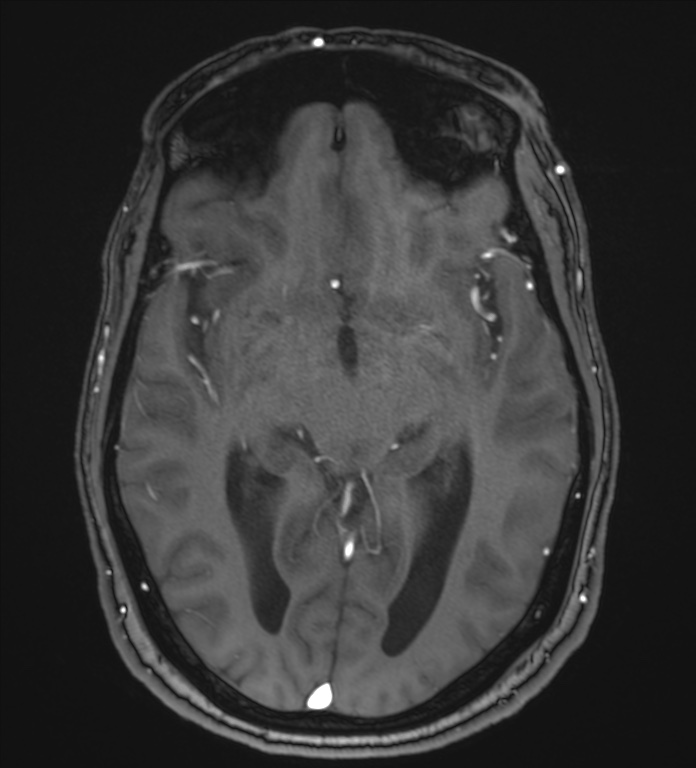 Cerebellopontine angle meningioma (Radiopaedia 72983-83680 Axial MRA 57).jpg