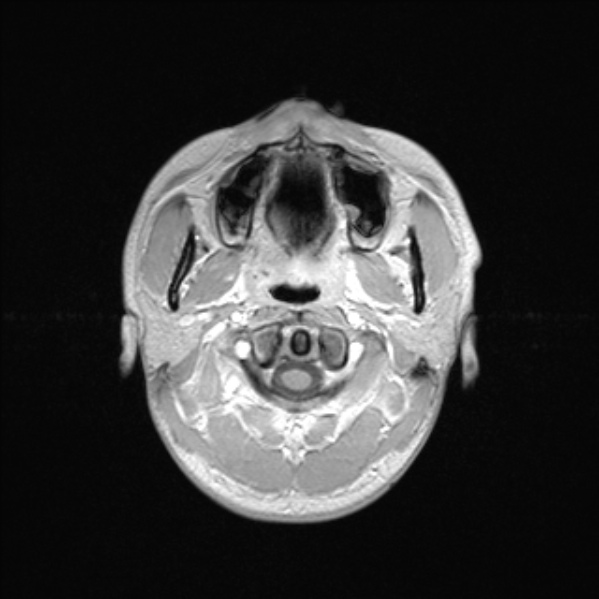 Cerebral abscess (Radiopaedia 24212-24478 Axial T1 C+ 6).jpg