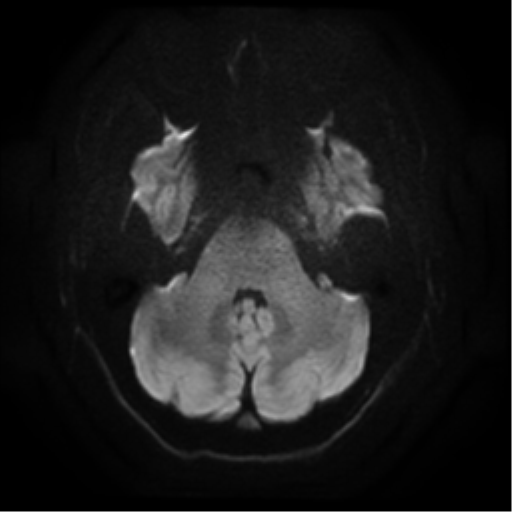 Cerebral abscess (Radiopaedia 57774-64740 Axial DWI 6).png