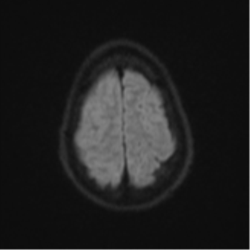 File:Cerebral abscess (Radiopaedia 60342-68009 Axial DWI 67).png