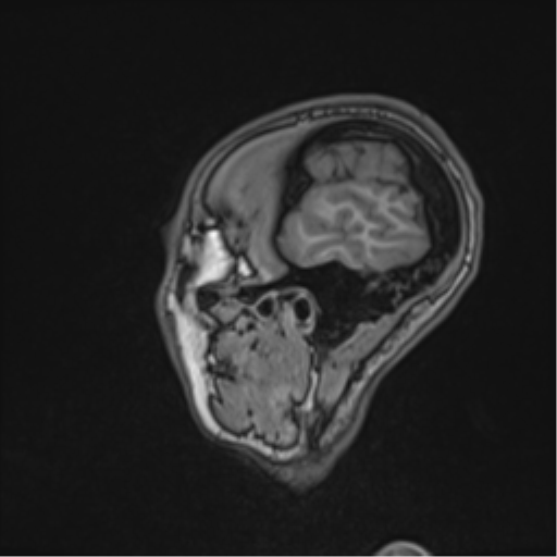 File:Cerebral abscess (Radiopaedia 60342-68009 Sagittal T1 10).png