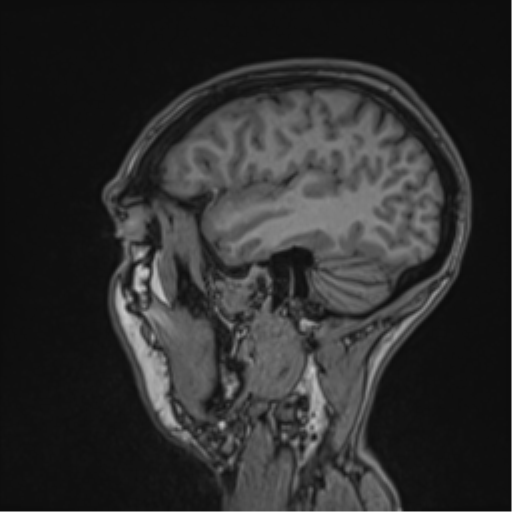 Cerebral abscess (Radiopaedia 60342-68009 Sagittal T1 15).png
