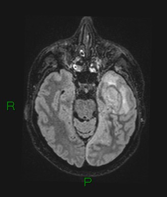 Cerebral abscess and subdural empyema (Radiopaedia 84436-99779 Axial FLAIR 55).jpg