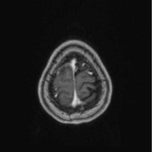 Cerebral abscess from pulmonary arteriovenous malformation (Radiopaedia 86275-102291 Axial T1 C+ 69).png
