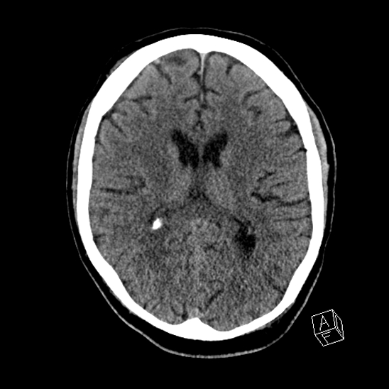 Cerebral abscess with ventriculitis (Radiopaedia 78965-91876 Axial non-contrast 28).jpg