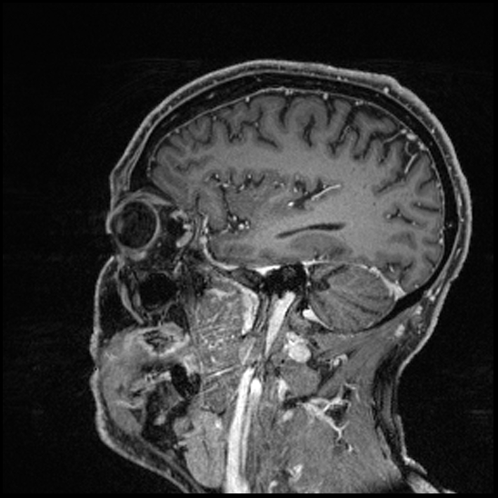 Cerebral abscess with ventriculitis (Radiopaedia 78965-91878 Sagittal T1 C+ 131).jpg
