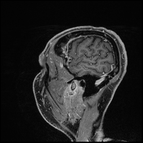 Cerebral abscess with ventriculitis (Radiopaedia 78965-91878 Sagittal T1 C+ 155).jpg