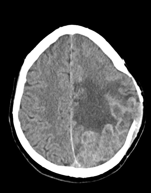 Cerebral abscesses (Radiopaedia 70458-80568 Axial non-contrast 44).jpg