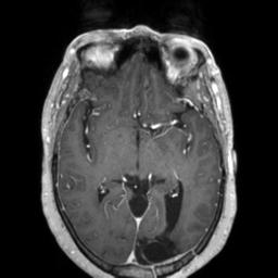 File:Cerebral amyloid angiopathy (Radiopaedia 29129-29518 Axial T1 C+ 69).jpg