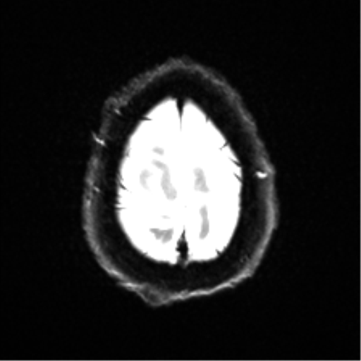 Cerebral amyloid angiopathy (Radiopaedia 46082-50433 Axial DWI 25).png