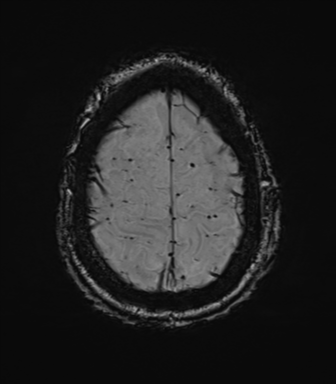 Cerebral amyloid angiopathy (Radiopaedia 46082-50433 Axial SWI 75).png
