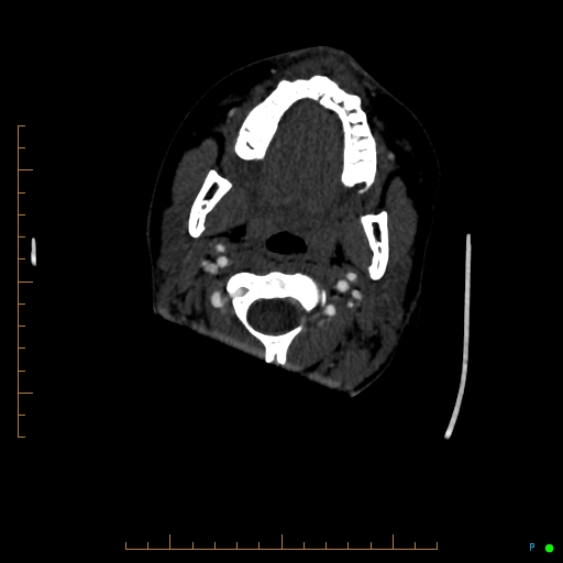 Cerebral arteriovenous malformation (AVM) (Radiopaedia 78162-90706 Axial CTA 14).jpg