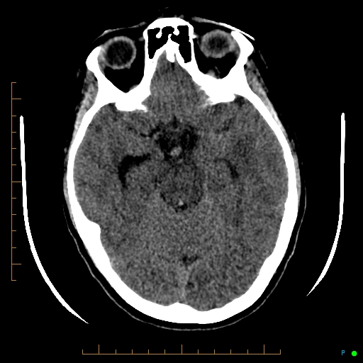 Cerebral arteriovenous malformation (AVM) (Radiopaedia 78162-90706 Axial non-contrast 25).jpg