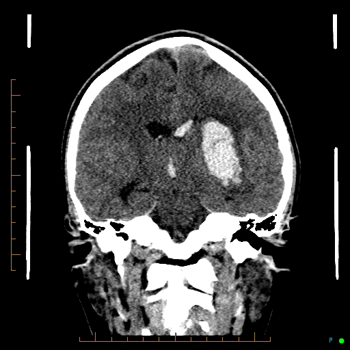 Cerebral arteriovenous malformation (AVM) (Radiopaedia 78162-90706 Coronal non-contrast 53).jpg
