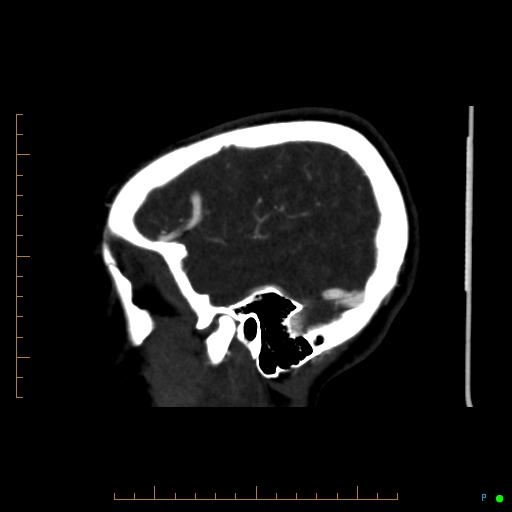 Cerebral arteriovenous malformation (AVM) (Radiopaedia 78162-90706 Sagittal CTA 16).jpg