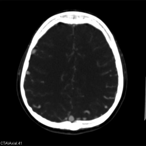 File:Cerebral arteriovenous malformation (Radiopaedia 28518-28759 B 41).jpg