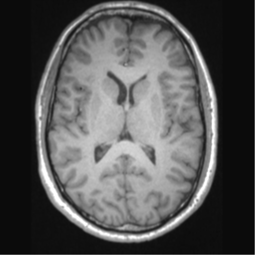 Cerebral arteriovenous malformation (Radiopaedia 39259-41506 Axial T1 43).png