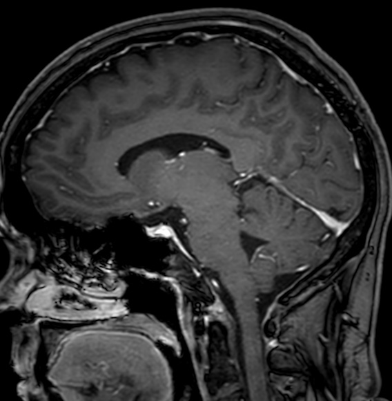 Cerebral arteriovenous malformation (Radiopaedia 74411-85746 Sagittal T1 C+ 58).jpg