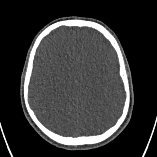 Cerebral arteriovenous malformation (Radiopaedia 78188-90746 Axial non-contrast 123).jpg