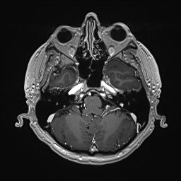 File:Cerebral arteriovenous malformation (Radiopaedia 84015-99245 Axial T1 C+ 42).jpg