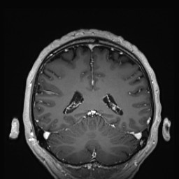 Cerebral arteriovenous malformation (Radiopaedia 84015-99245 Coronal T1 C+ 112).jpg