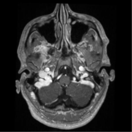 Cerebral arteriovenous malformation - huge (Radiopaedia 35734-37272 Axial T1 C+ 9).png