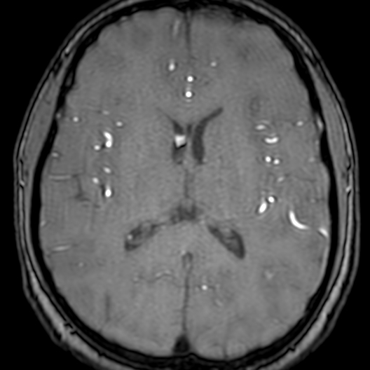 Cerebral arteriovenous malformation at posterior body of corpus callosum (Radiopaedia 74111-84925 Axial MRA 124).jpg
