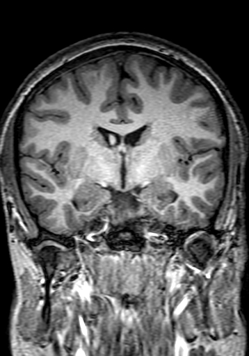 File:Cerebral arteriovenous malformation at posterior body of corpus callosum (Radiopaedia 74111-84925 Coronal T1 149).jpg