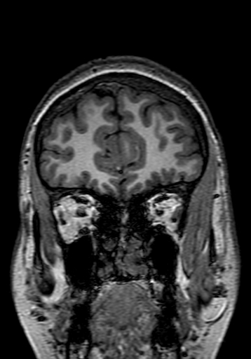 Cerebral arteriovenous malformation at posterior body of corpus callosum (Radiopaedia 74111-84925 Coronal T1 43).jpg