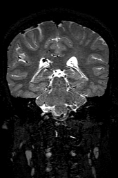 Cerebral arteriovenous malformation at posterior body of corpus callosum (Radiopaedia 74111-84925 Coronal T2 110).jpg