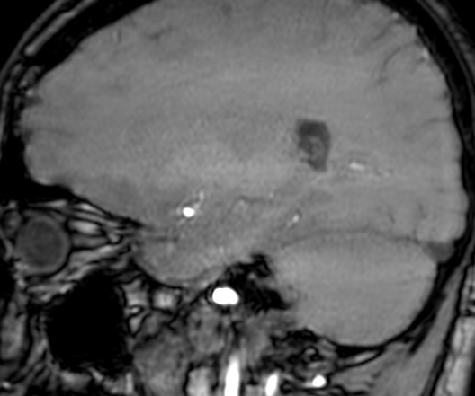 File:Cerebral arteriovenous malformation at posterior body of corpus callosum (Radiopaedia 74111-84925 J 267).jpg