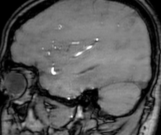 Cerebral arteriovenous malformation at posterior body of corpus callosum (Radiopaedia 74111-84925 J 305).jpg