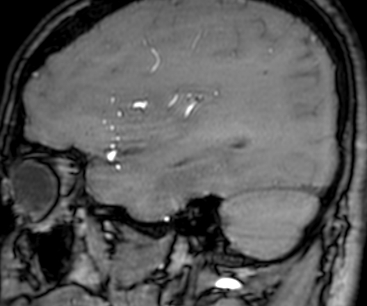 Cerebral arteriovenous malformation at posterior body of corpus callosum (Radiopaedia 74111-84925 J 86).jpg